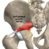 cond-sciatica